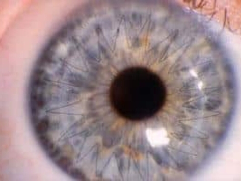 Corneal Transplantation PKT training course