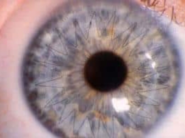 Corneal Transplantation PKT training course