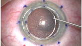 Dalk Assisted By Femto Laser Training Course