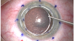 Dalk Assisted By Femto Laser Training Course