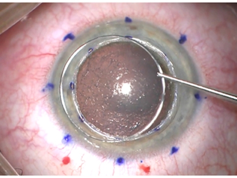 Dalk Assisted By Femto Laser Training Course