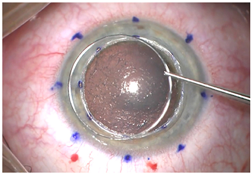 Dalk Assisted By Femto Laser Training Course